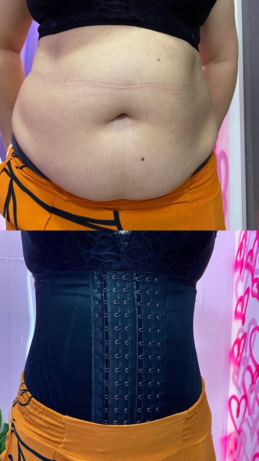 Abdômen de frente antes e depois de fechar a cinta preta